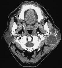 Sol Parotis bezi tümörü